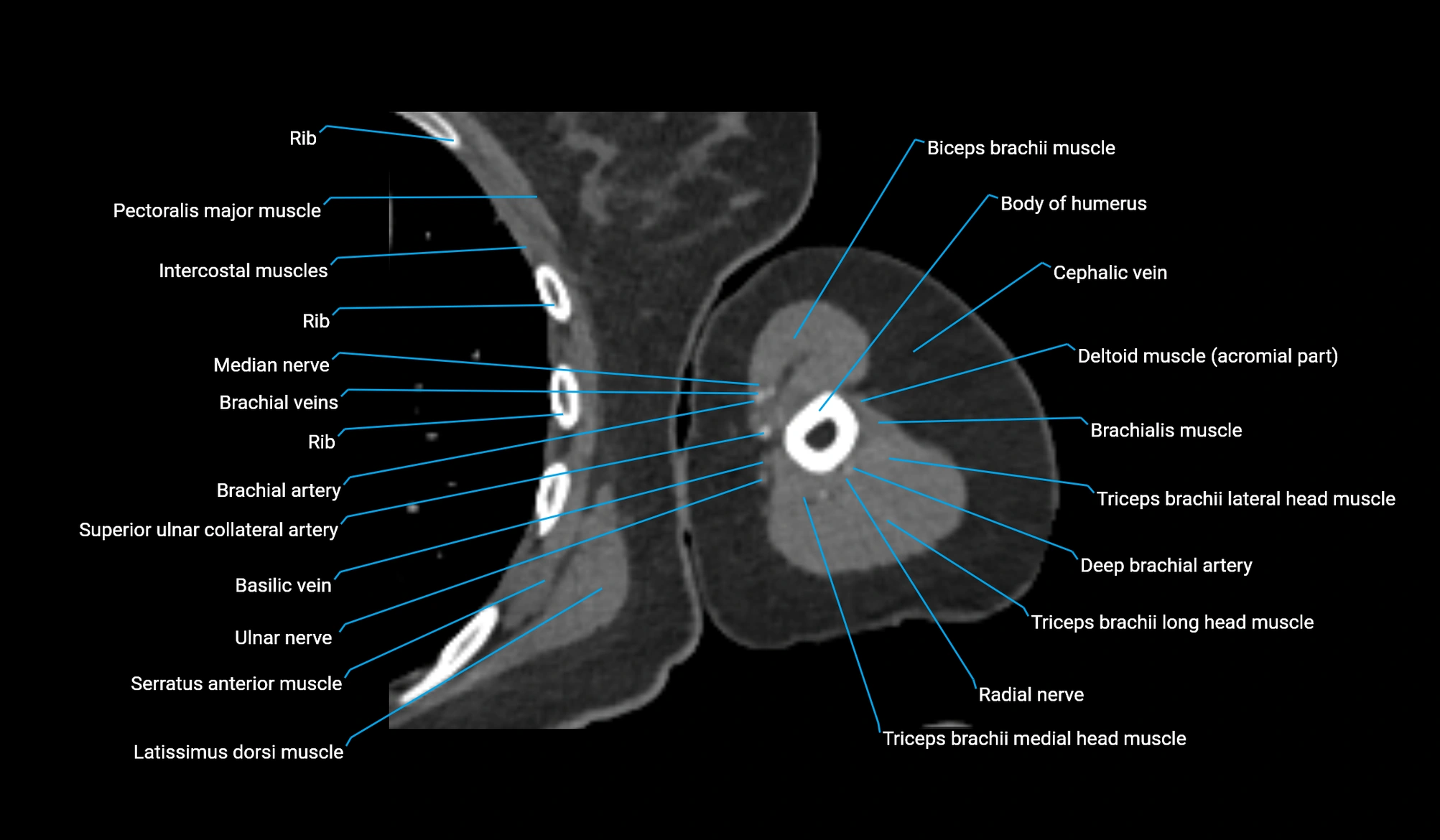 CT upper arm axial  cross sectional anatomy labelled radiology image -00230.webp